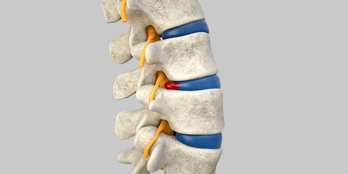 disc injury chiropractor in Austin TX